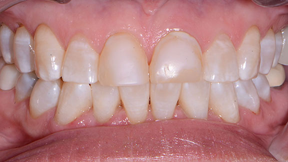 Smile Gallery | Dental Treatment Before Photo