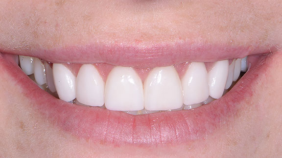 Smile Gallery | Dental Treatment After Photo