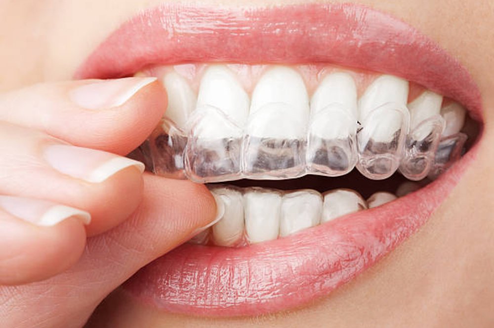 Invisalign Cost