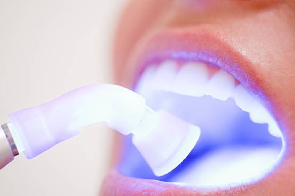 Laser Teeth Whitening